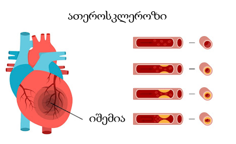 ischemia