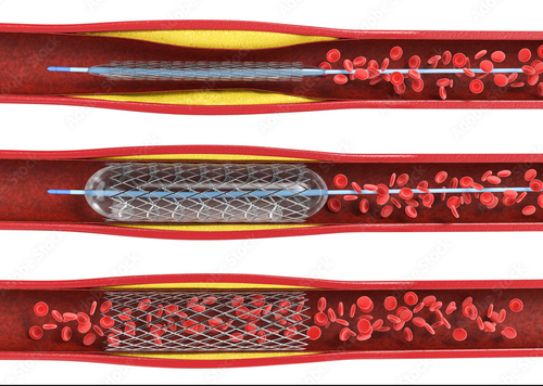 stenting
